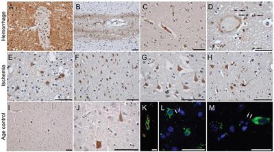 Monomeric C-Reactive Protein and Cerebral Hemorrhage: From Bench to Bedside